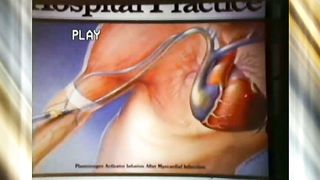 Эстер 19 Сердечно-сосудистые заболевания